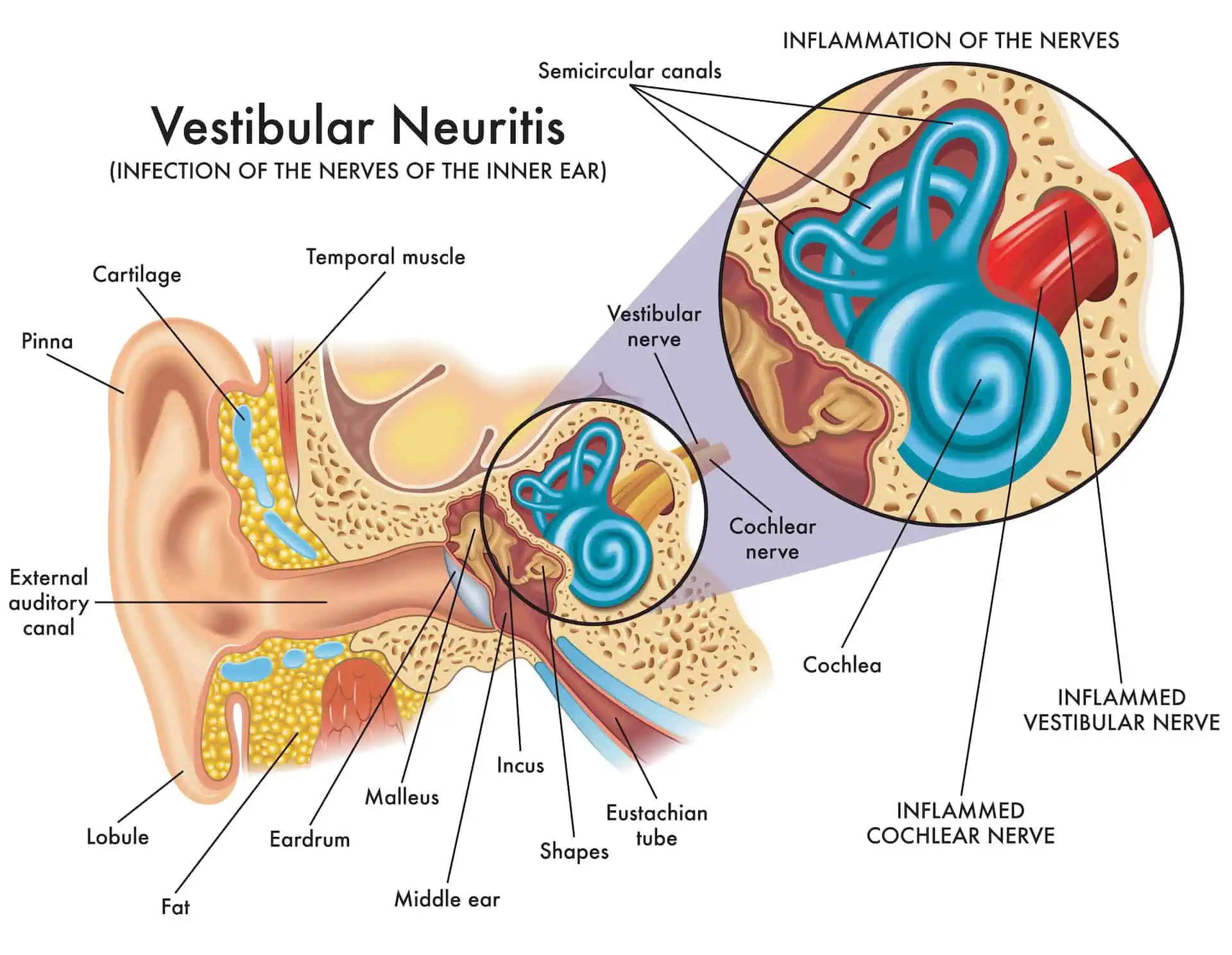 Vestibular Neuritis